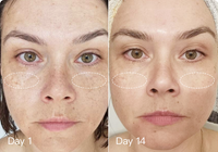 Megelin LED Light Therapy Machine - Can further improve your Pigmentation and Uneven Tone skin