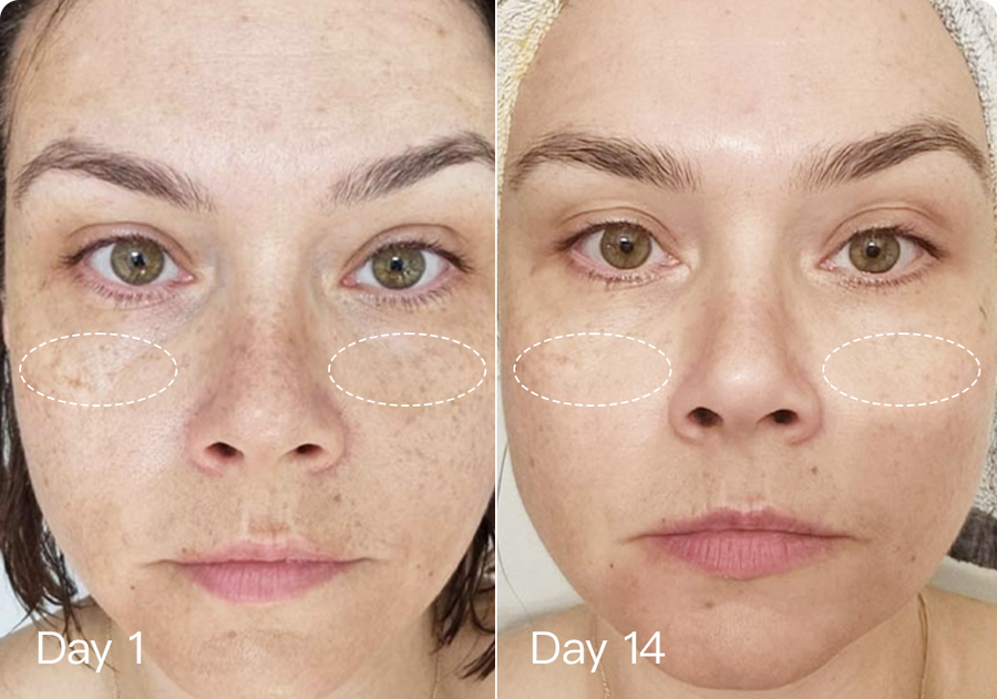 Megelin LED Light Therapy Machine - Can further improve your Pigmentation and Uneven Tone skin