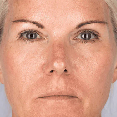 Wrinkles After