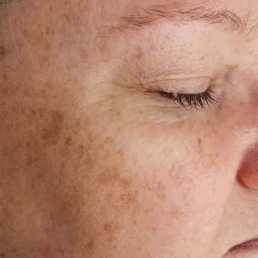 Pigmentation Before