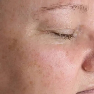 Pigmentation After