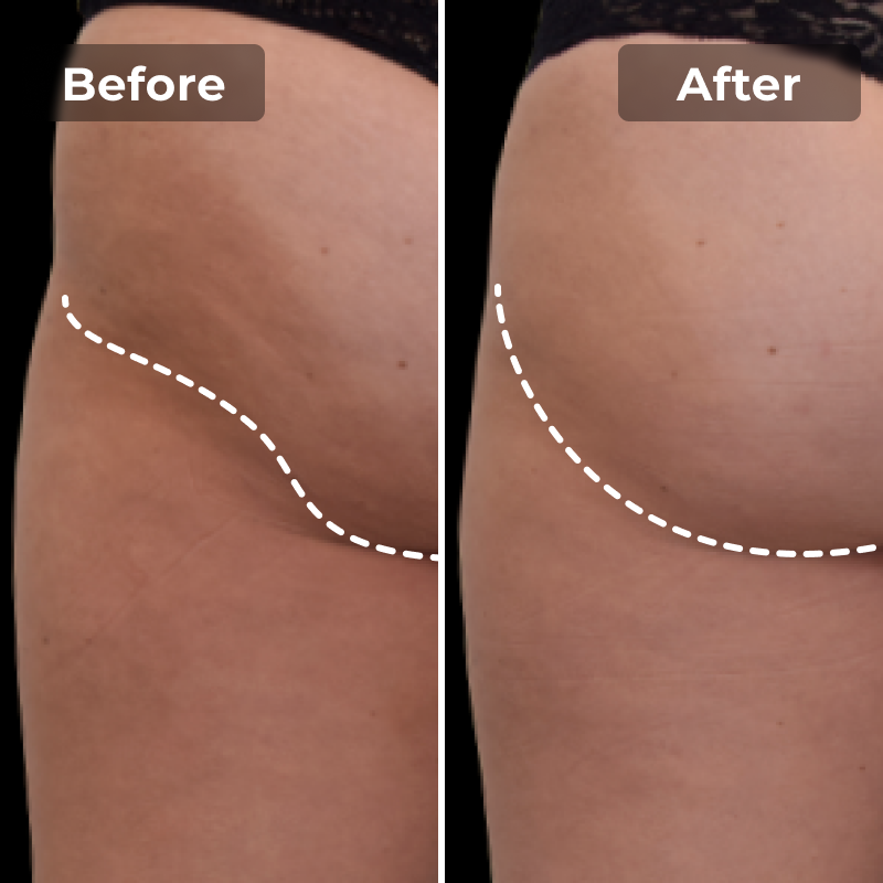 EMS Toning Shorts - Megelin