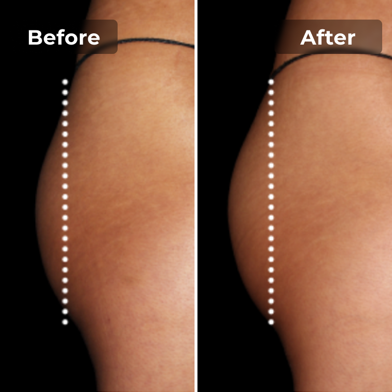 EMS Toning Shorts - Megelin