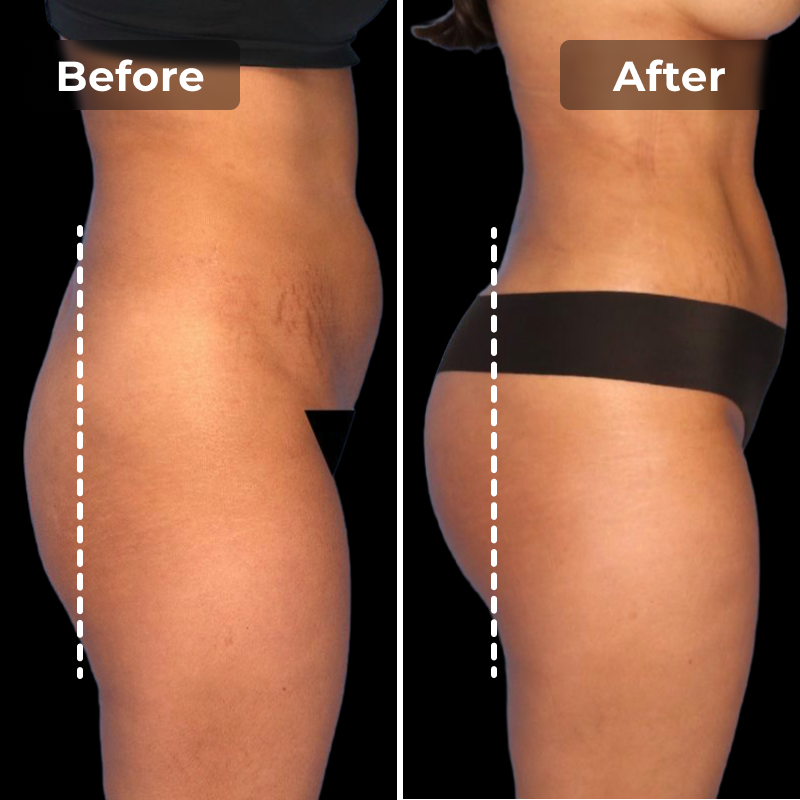 EMS Toning Shorts - Megelin