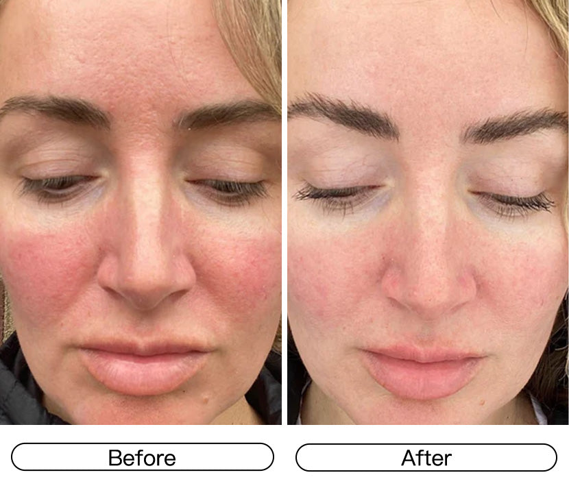 Soothes Red, Irritated Skin Instantly.