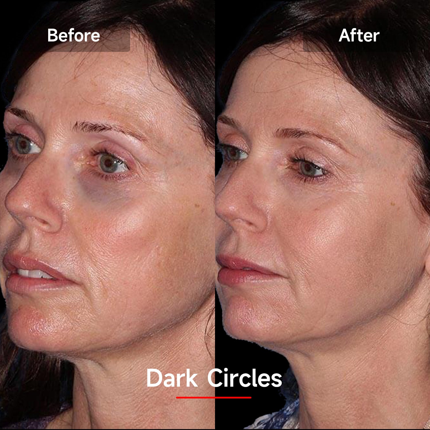 LASER&LED LIGHT Therapy Mask - Megelin