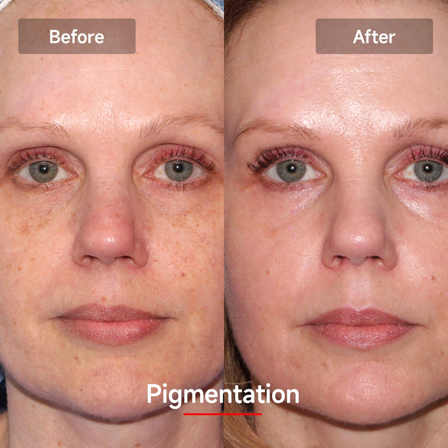 LASER&LED LIGHT Therapy Mask - Megelin