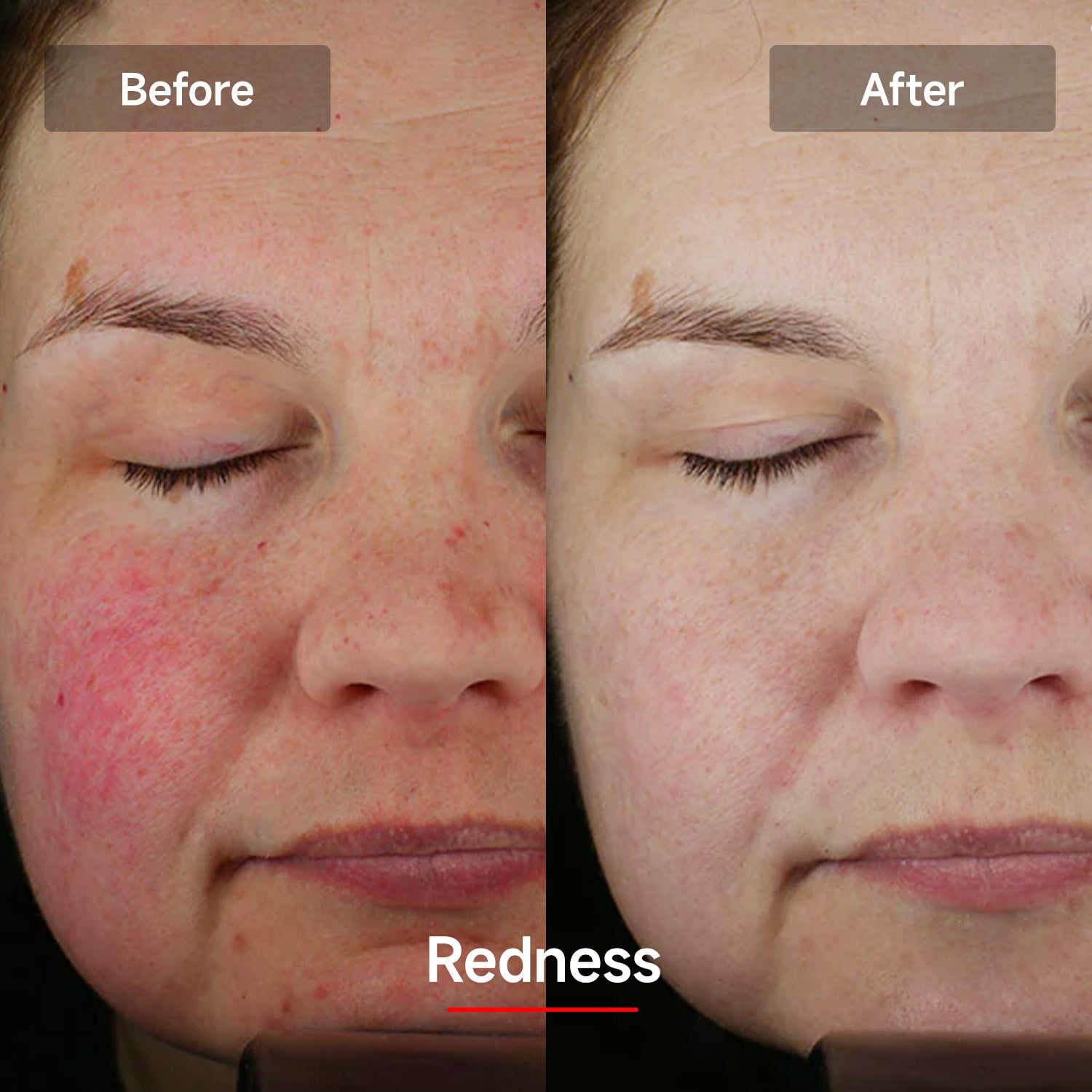 LASER&LED LIGHT Therapy Mask - Megelin