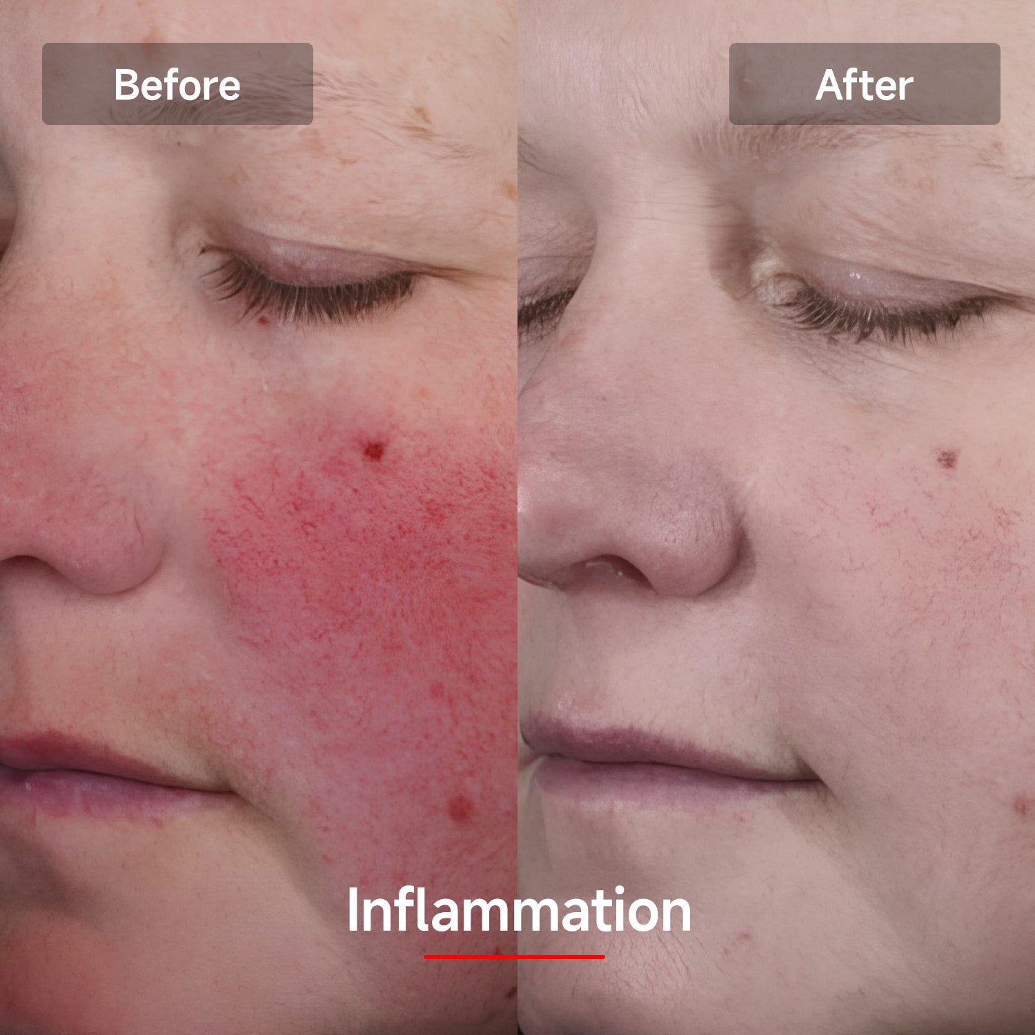 LASER&LED LIGHT Therapy Mask - Megelin