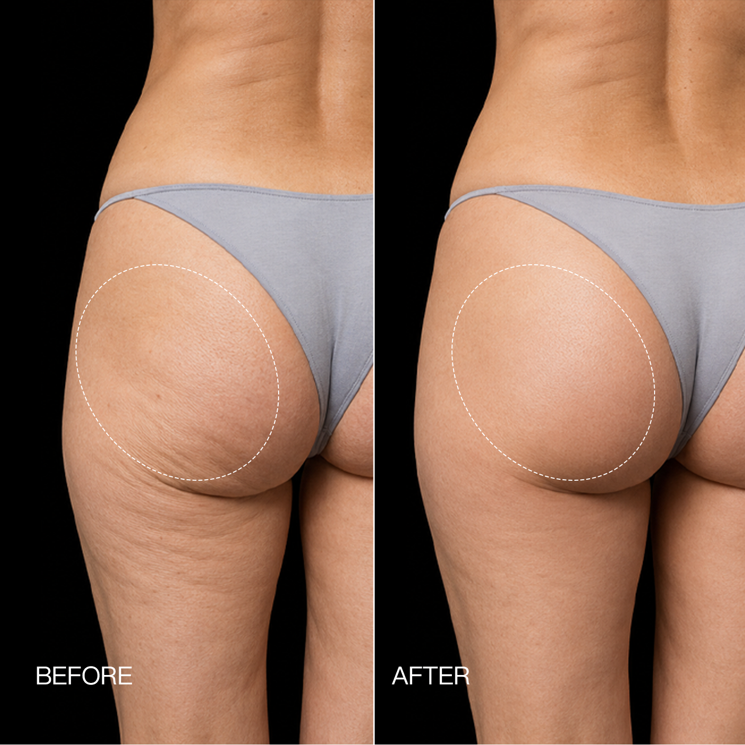 Megelin EMS Toning Shorts