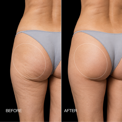 Megelin EMS Toning Shorts