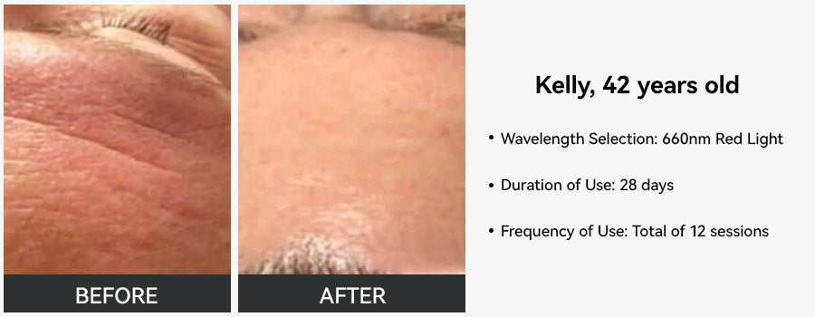 See What Red Light Therapy Did To My Wrinkles You Wont Believe It Before After - ms486un