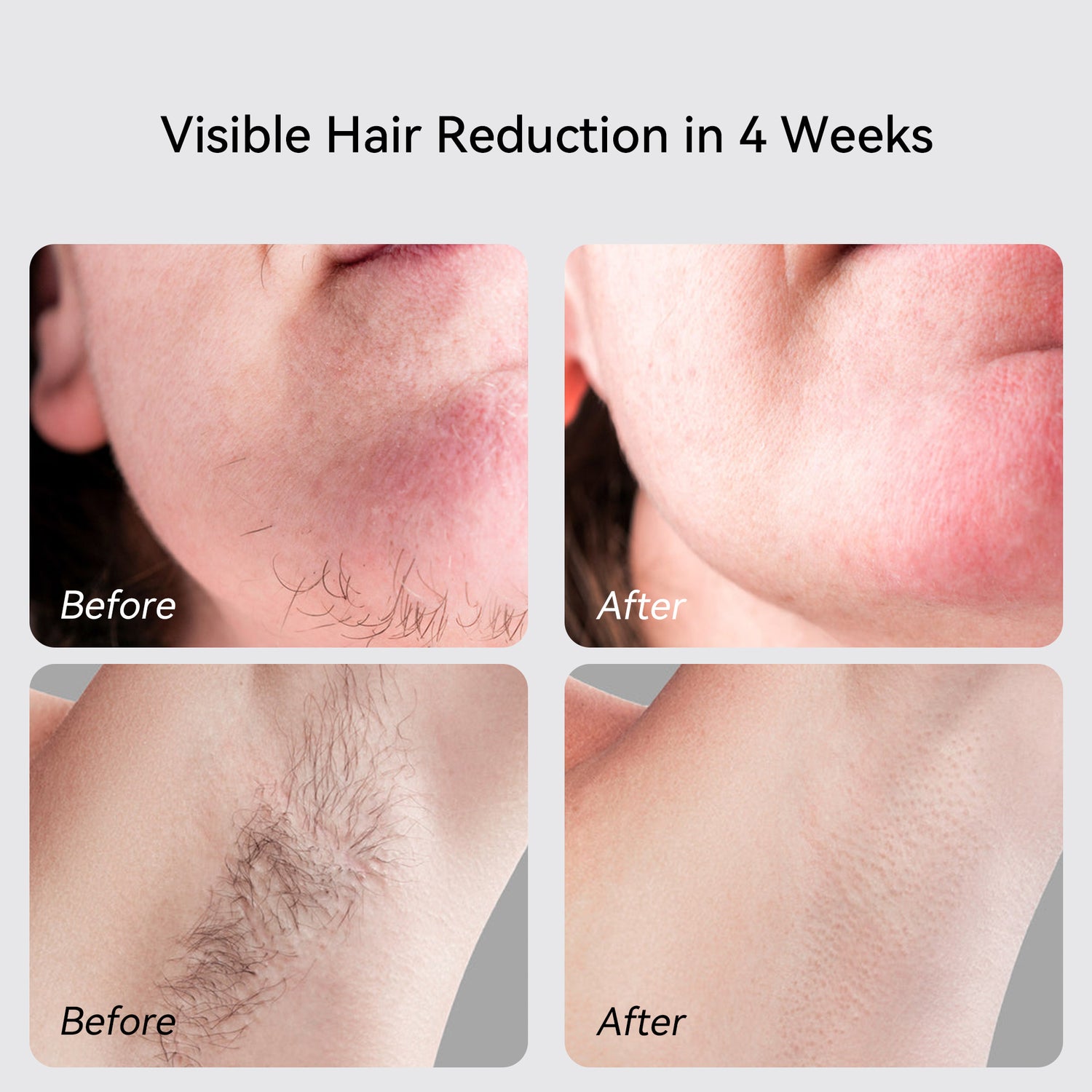 Can I Use IPL Laser Hair Removal on my Face?