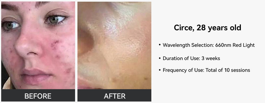 From Dull To Dazzling My Red Light Therapy Before After Results - t0639tg