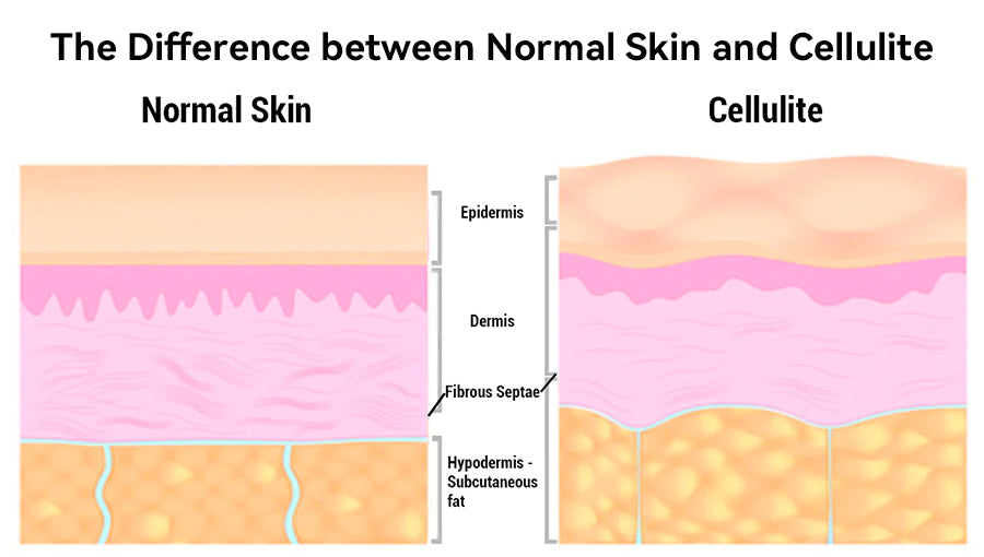 Red Light Therapy For Cellulite 50 Users Results Before and After