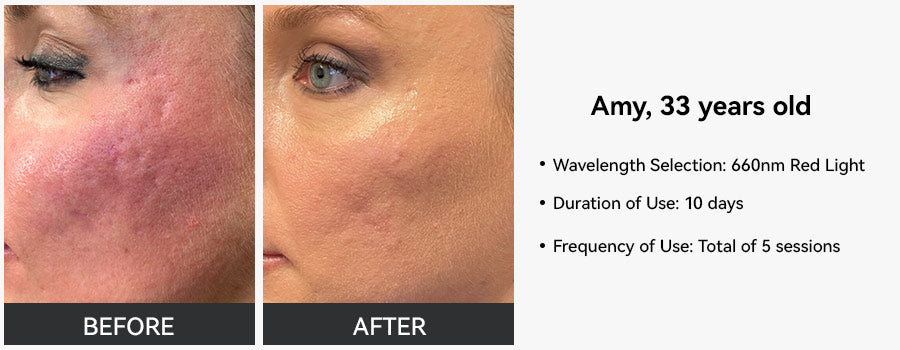 Red Light Therapy Before and After| 2024 New Trusted Cases – Megelin