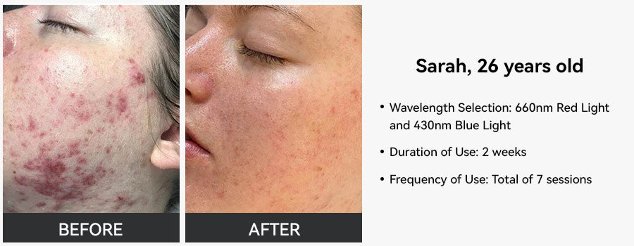 Red Light Therapy Before and After| 2024 New Trusted Cases – Megelin